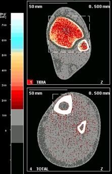 Peripheral Quantitative Computed Tomography PQCT HR PQCT SCIRE