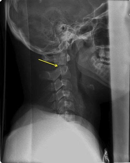 Cervical Spine X Ray Lateral View Odontoid Peg Injury X Ray