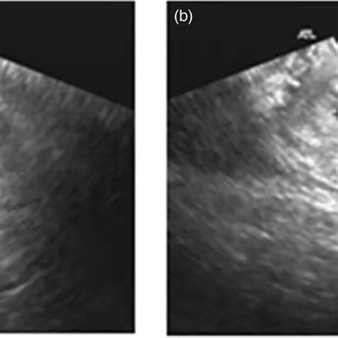 A Typical Transvaginal Ultrasound Image With Contoured Target Volume Download Scientific Diagram