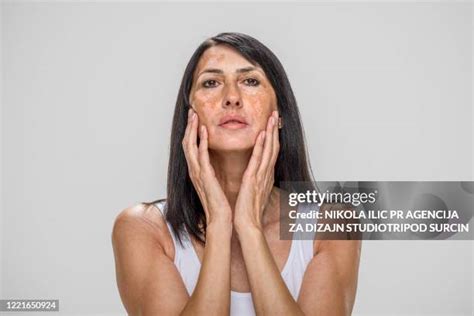 Vitiligo Skin Face Photos and Premium High Res Pictures - Getty Images