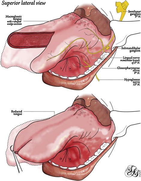 Surgical Treatment Of Macroglossia In Patients With BeckwithWiedemann