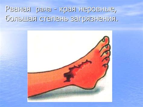 Ранения. Виды ран - презентация онлайн