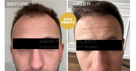 Gallery Nyc Hair Transplant Nova Medical