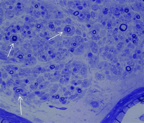 Sural Nerve Biopsy Semi Thin Section Note Rarefaction Of Myelinated