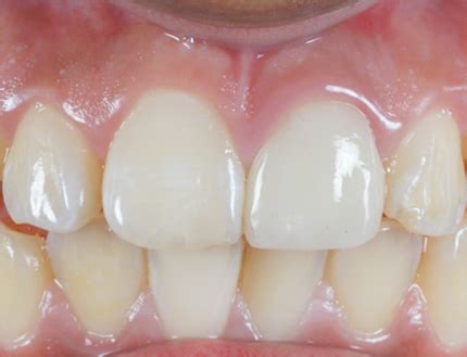 Procedimientos Combinados Caso Cosm Tica Dental Burga