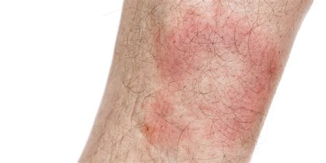 Erythema Migrans Ursachen Und Behandlung Heilpraxis