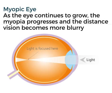 Myopia Management Ashton Opticians