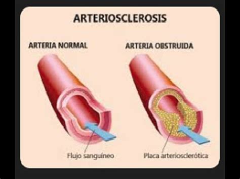 SISTEMA CIRCULATORIO MALA CIRCULACIÓN NATURISTA DR RAÚL YouTube