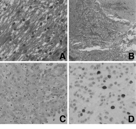 Photomicrographs of the resected specimen showing pilocytic astrocytoma ...