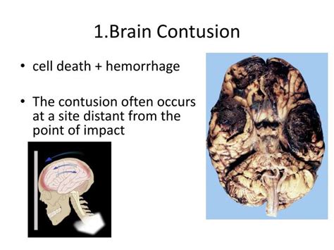 PPT - Traumatic Brain Injuries PowerPoint Presentation - ID:3453604