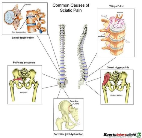 Sciatica Lumbar Radiculopathy Wake Spine Pain