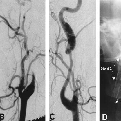 An Year Old Man Patient With A History Of Aortic Dissection