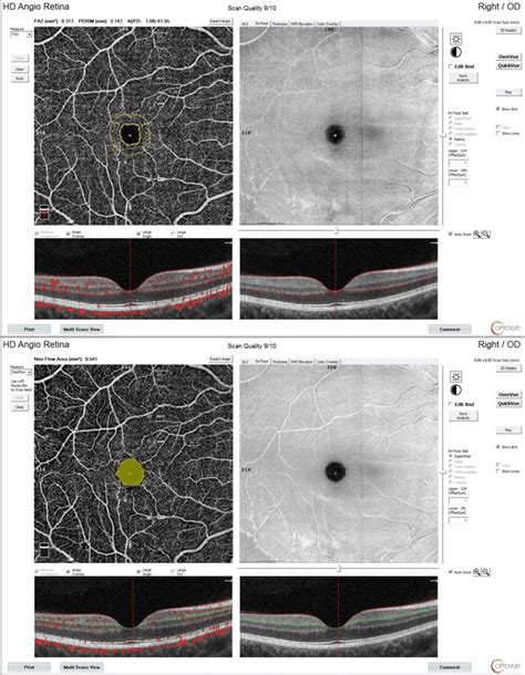 Foveal Avascular Zone Top And Non Flow Area Bottom Download Scientific Diagram