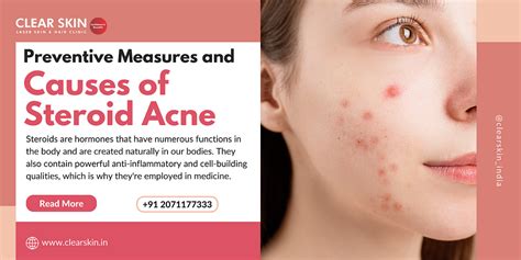 Preventive Measures And Causes Of Steroid Acne By Clearskin Laser