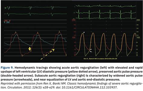 Hemodynamics That Can Make For A Lifesaving Decision In The Cath Lab