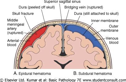 Chapter 29 Head And Spine Injuries Flashcards Quizlet