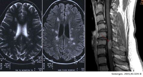 Revisi N De La Esclerosis M Ltiple Diagn Stico Y Tratamiento