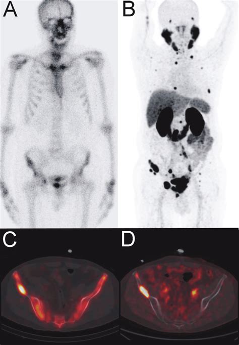 Tc 99m Mdp Bone Scintigraphy Planar A And Fused Spect Ct C Images