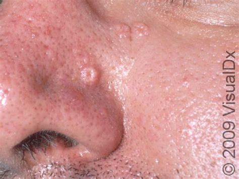 Sebaceous Hyperplasia Condition Treatments And Pictures For Adults