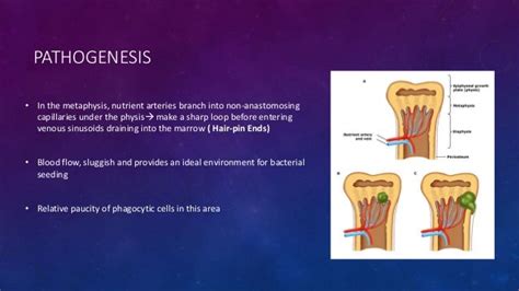 Hematogenous Osteomyelitis