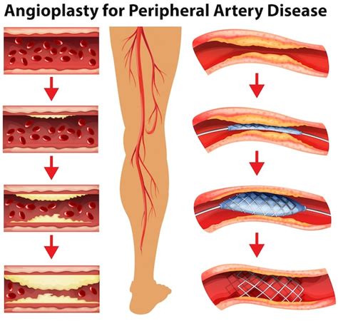 Peripheral Artery Disease Diagram