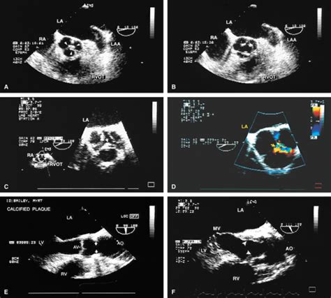 Aortic Valve Aorta And Aortic Branches Thoracic Key