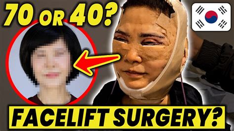 Unbelievable Korean Facelift Before & After! Mommy Makeover | Plastic ...