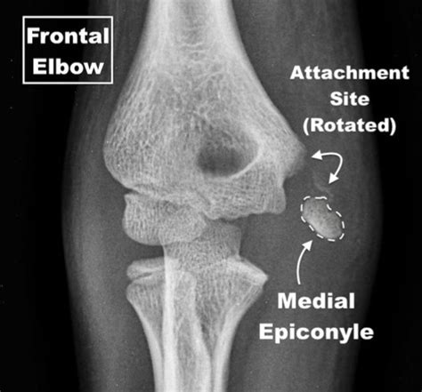 Medial Epicondyle Fractures In The Pediatric Population, 46% OFF