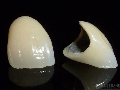 Porcelain Fused To Metal Pfm Crown Aria Irvani Dentistry Even