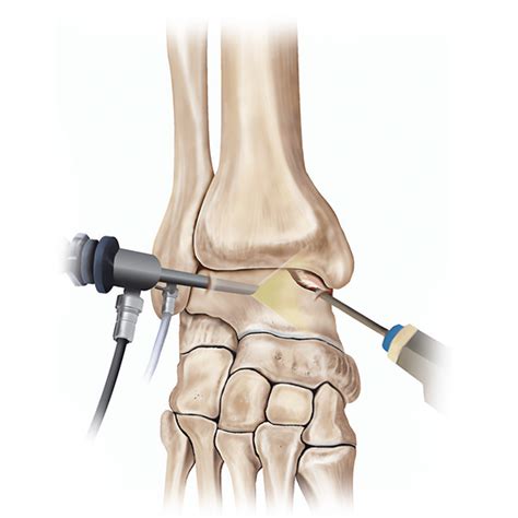 Ankle arthroscopy | CLLC Montréal, Dre Marie Gdalevitch