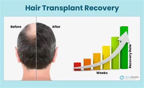 Hair Transplant Recovery - Time, After Care, Process & Pictures