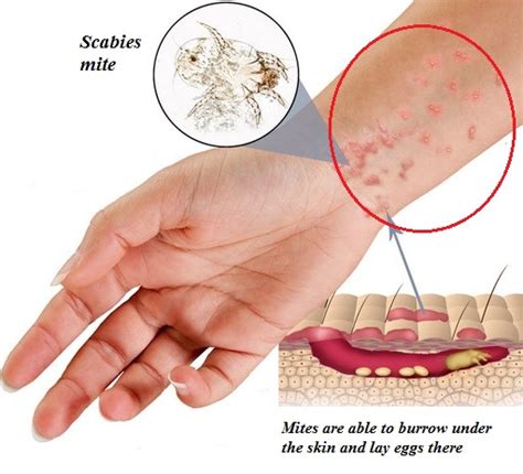 Scabies Skin Rash Pictures Causes Symptoms Home Remedy