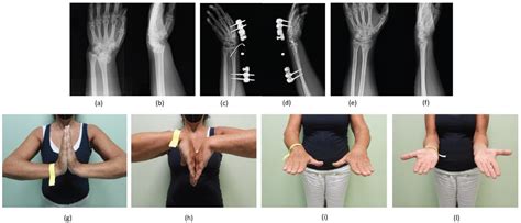 Jpm Free Full Text Treatment Of Distal Radius Fractures With Bridging External Fixator With