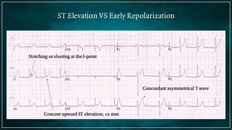 Electrocardiogram