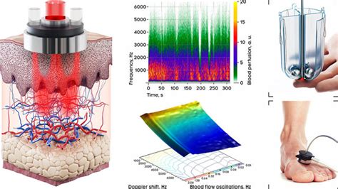 Diagnosis Of Skin Vascular Complications Revealed By Time Frequency