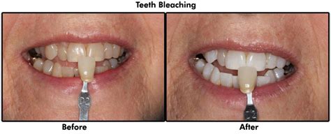 Teeth Bleaching - Dentists Peterborough | Dentistry on Sherbrooke