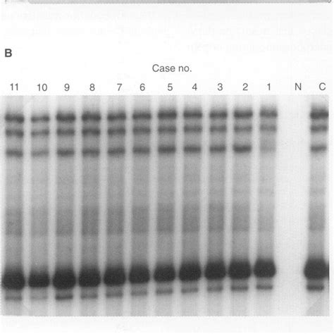 A Pcr Sscp Analysis Of The Ela Segment Of The P21 Gene Non Glycerol