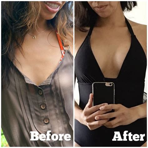 Wrapping Up My Breast Augmentation Story Breast Implants Sizes