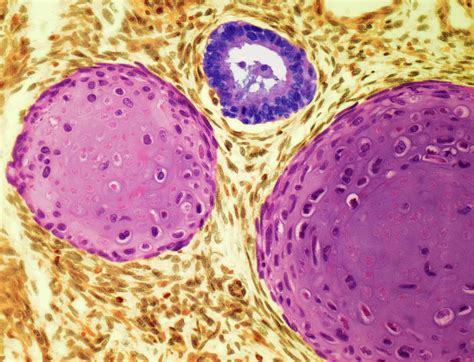 Testicular Cancer Photograph By Steve Gschmeissnerscience Photo