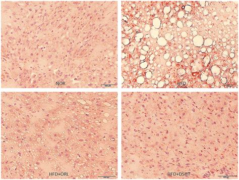 Effect Of DSHT On HFD Induced Histopathological Changes Of Liver Tissue