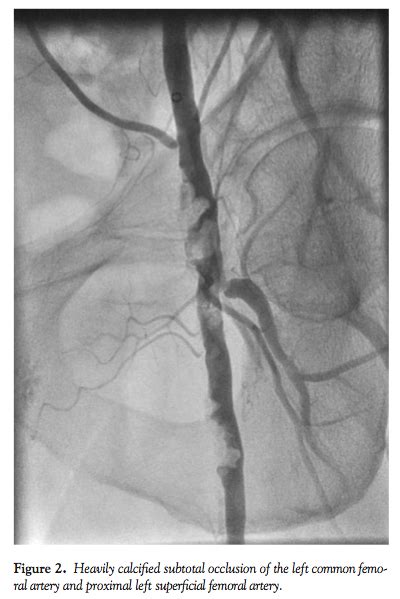 Common Femoral Artery Stenosis