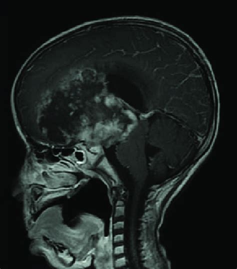 Sagittal T1 Weighted Magnetic Resonance Image Post Contrast