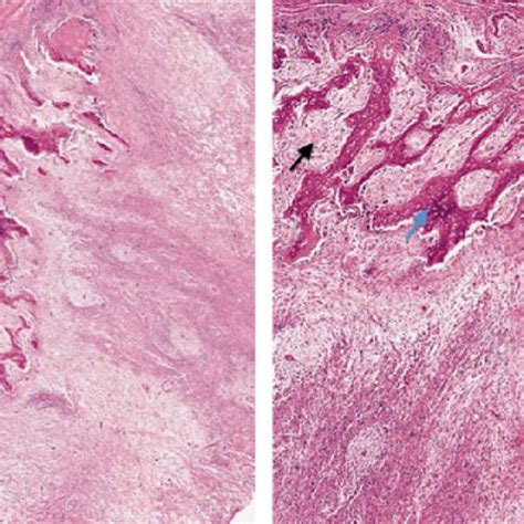 Low Power A And High Power B Histologic Specimens Of Myositis