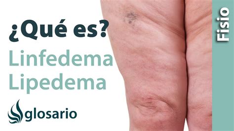 LINFEDEMA Y LIPEDEMA | ¿Qué son? - YouTube