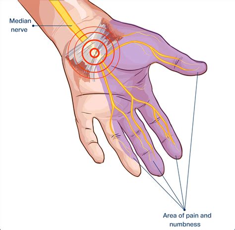 Carpal Tunnel Syndrome Treatment Melbourne Hand Therapy