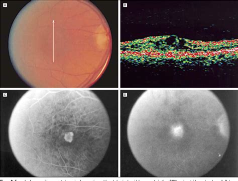 Cystoid Degeneration