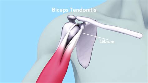 Causes Bicep Tendonitis