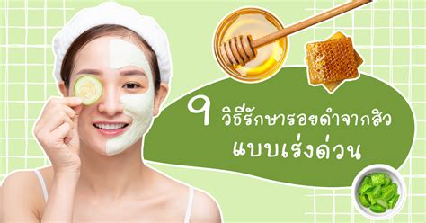 วิธีรักษารอยดำจากสิว เร็วที่สุด ต้องทำยังไงรอยสิวถึงจางไว มาดู