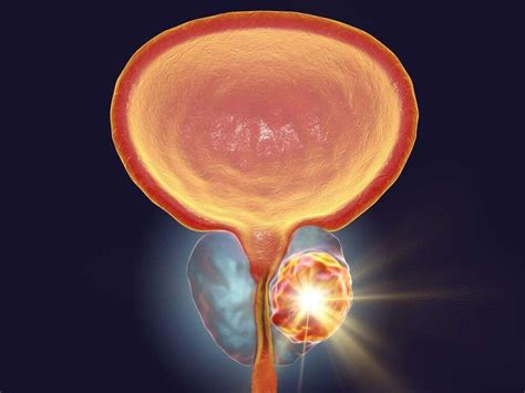 Enlarged Prostate: 10 Enlarged Prostate Symptoms