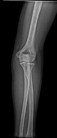 Isolated Ulna Shaft Fracture Radiology Case Radiopaedia Org